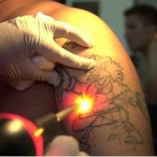 как вывести татуировку